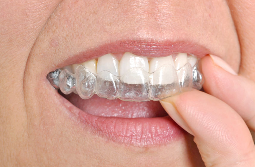 know about Invisalign