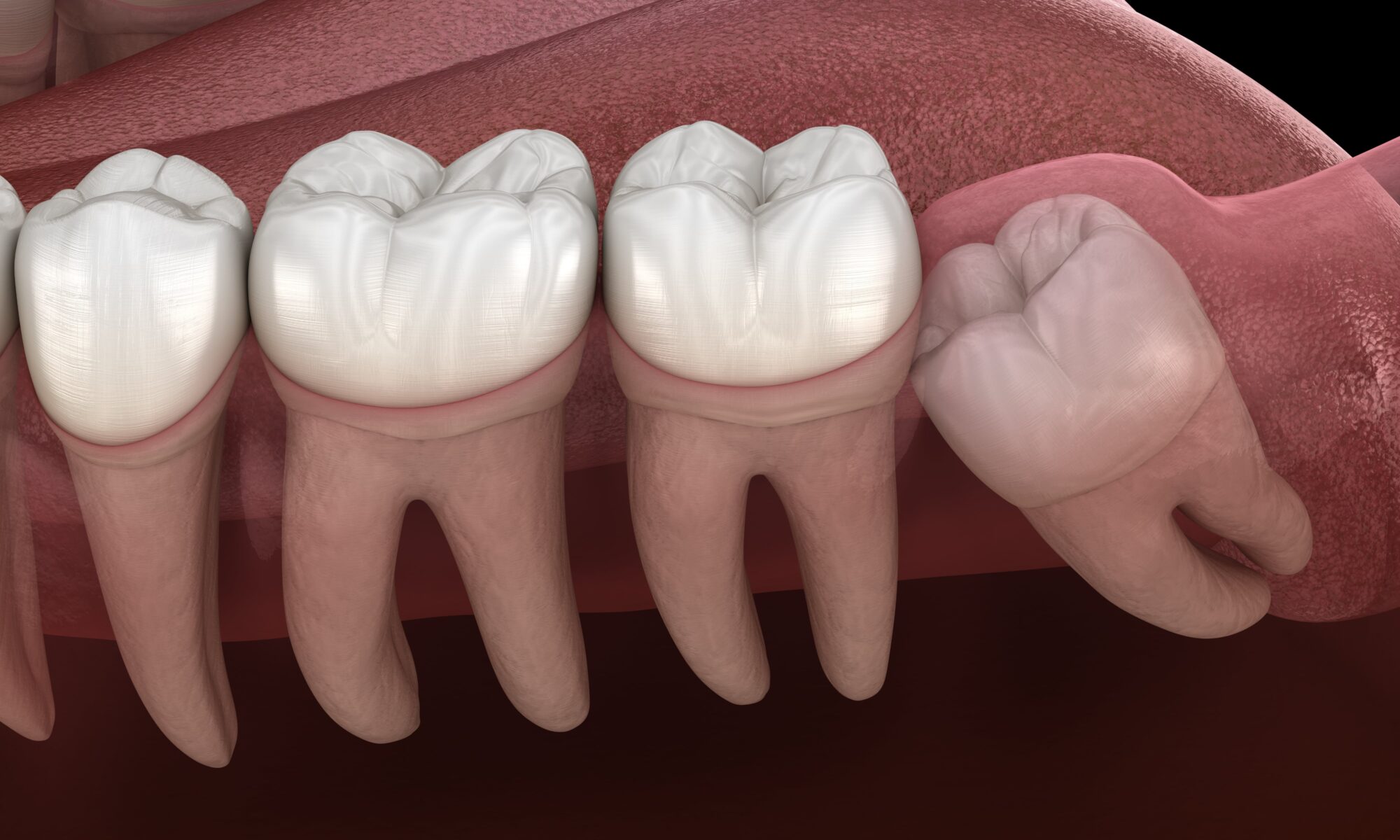wisdom teeth extraction price