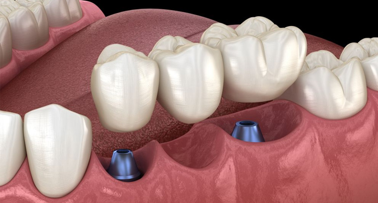 dental crowns bridges wollongong