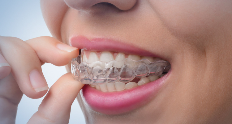 Warrawong invisalign