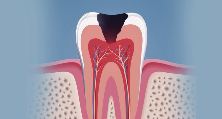 root canal treatment wollongong