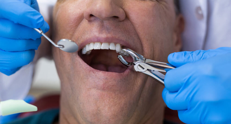 emergency tooth extraction wollongong