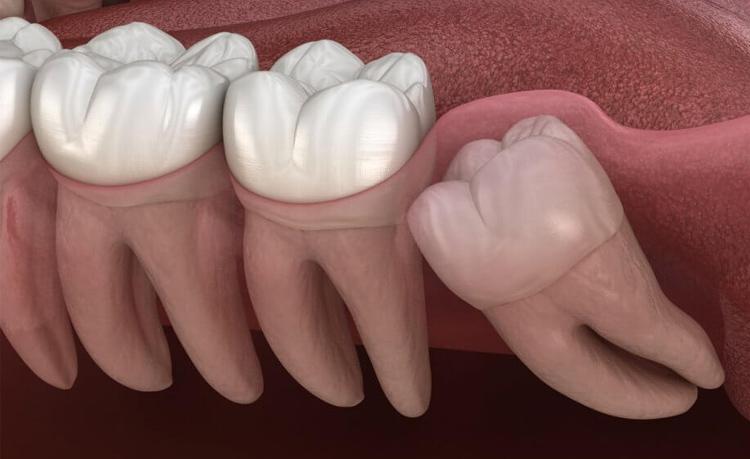 wisdom tooth extraction wollongong