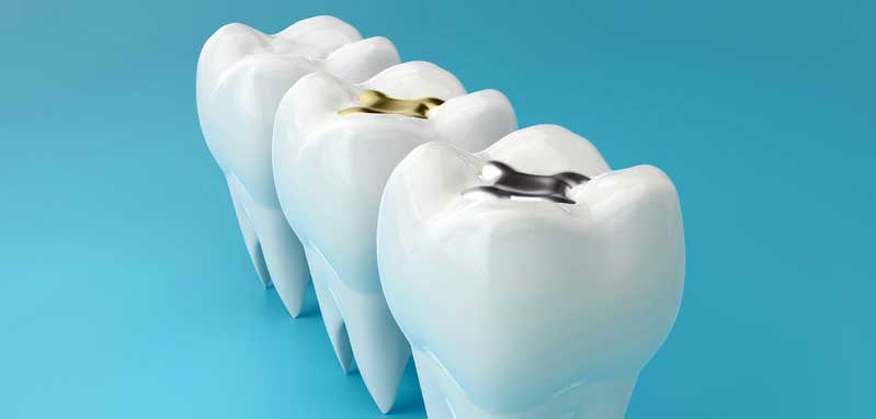 about dental fillings