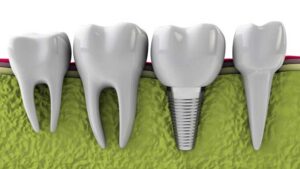 dental implants