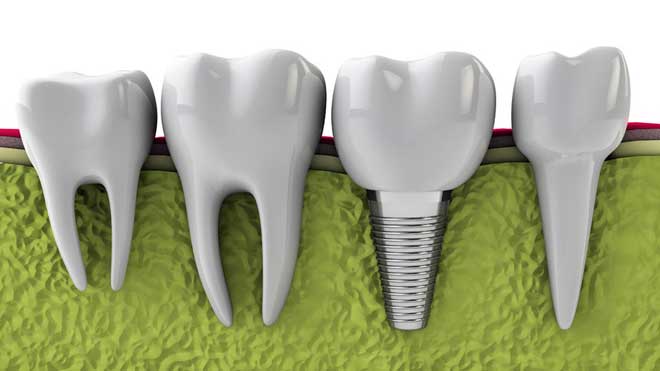 dental implants