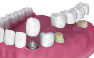Dental Implants