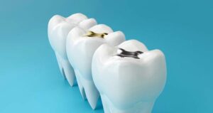 dental fillings falling out