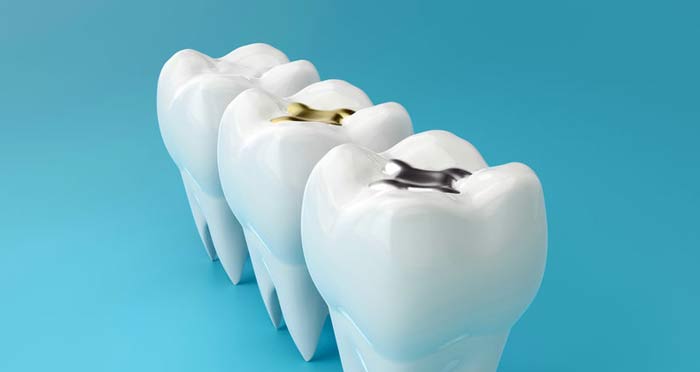 dental fillings falling out