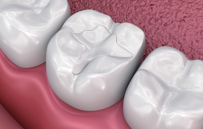 Type of Dental Fillings