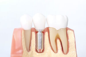 Can Dental Implants Help