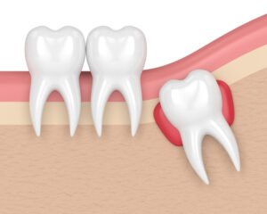 Need to Extract Your Wisdom Tooth
