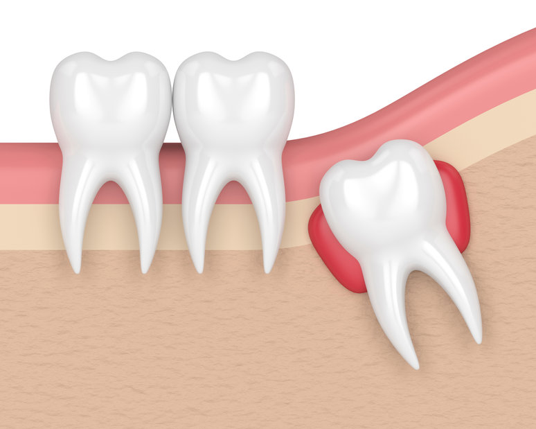 Need to Extract Your Wisdom Tooth