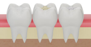 types of dental fillings