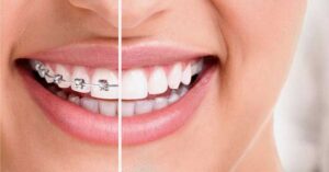 Invisalign Vs Braces