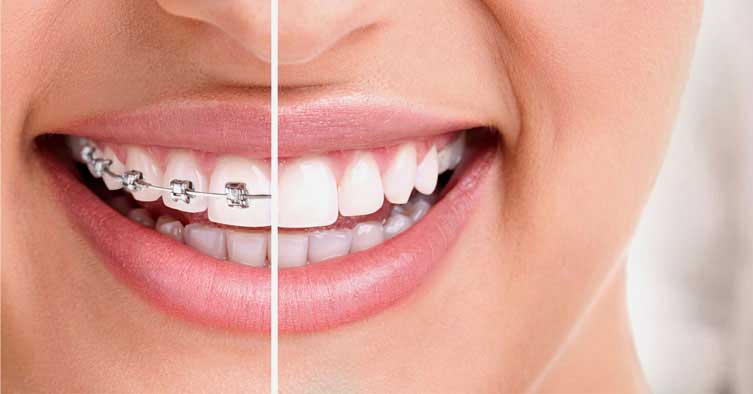 Invisalign Vs Braces