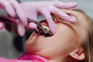 tooth extraction