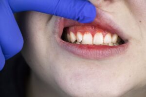 gingivitis symptoms